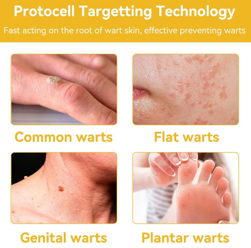 Bee Venam Wart & Mole Removel Cream
